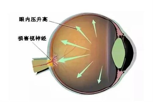 青光眼症状早期有哪些?该怎样预防呢?