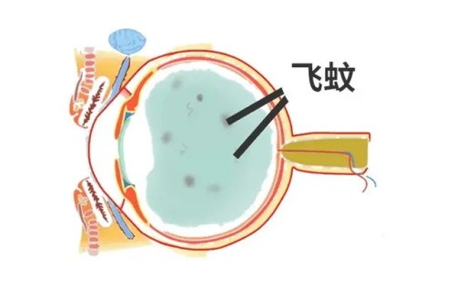 近视的人都有飞蚊症吗?怎样判断是不是飞蚊症呢?