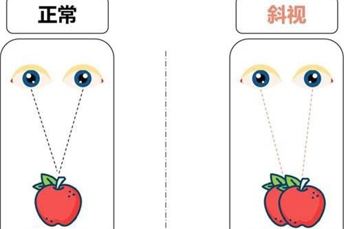 斜视眼睛矫正手术多少钱?谁知道2023年斜视手术报销吗