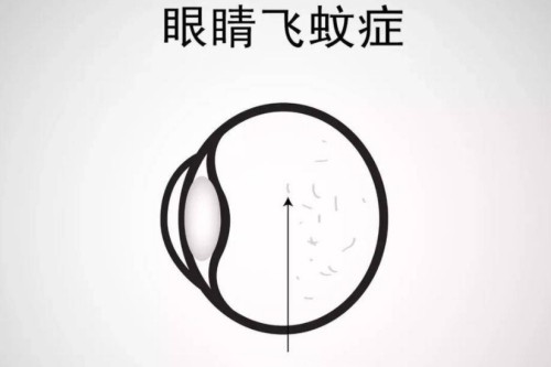 请问飞蚊症严重吗?一般多久会消失?