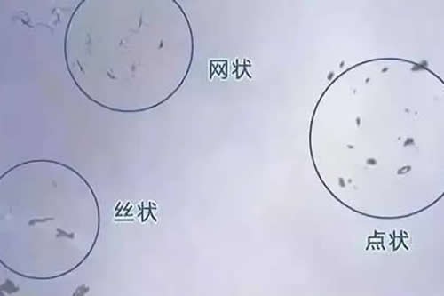 造成飞蚊症的原因有哪些,具体该如何治疗?