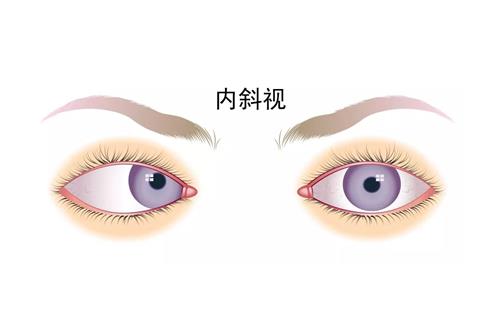 先天性麻痹性斜视手术能治好吗?首先考虑的治疗方法有啥