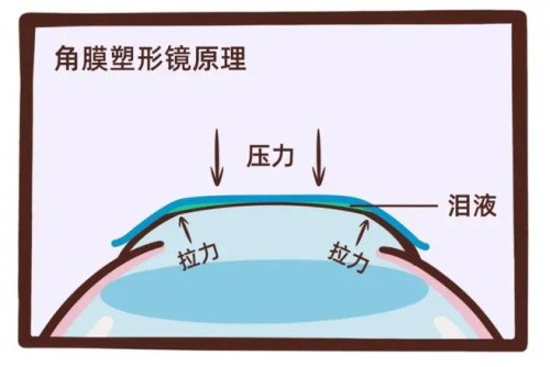 普诺瞳角膜塑形镜好不好?它的优点和缺点有什么?