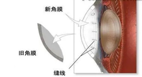 角膜移植后眼睛还和原来一样吗?术后多久能变成正常?