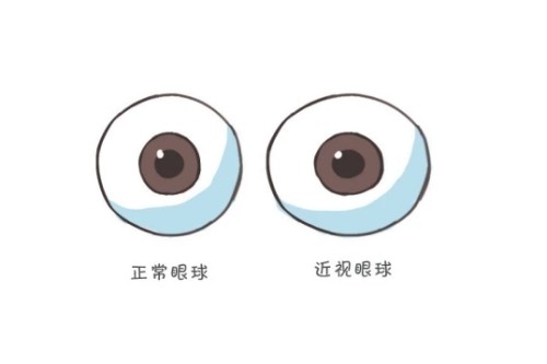 角膜塑形镜到底是什么?角膜塑形镜真的可以治疗近视吗?