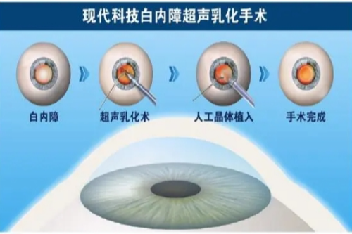 白内障超声乳化吸出术:手术原理+恢复周期+注意事项