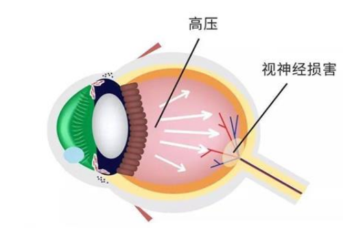 青光眼冷冻术能保持多久?术后还可能复发吗?