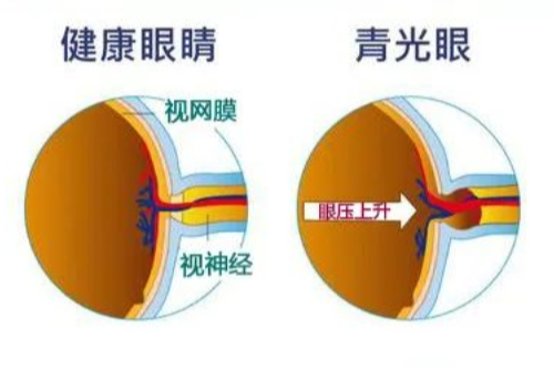 【眼病答疑系列】青光眼一定会导致失明吗?