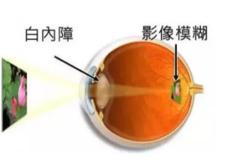 眼科医生解答:白内障非要到成熟期才手术吗?
