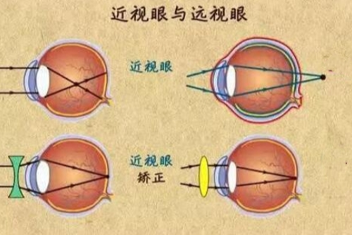 三焦点晶体植入术治疗范围:近视/远视/白内障一站式解决