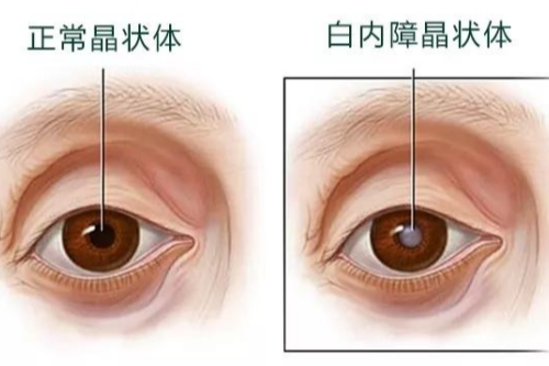 眼科医生为大家解答:白内障要等到视力0.3才能做吗?