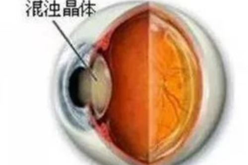 眼科新秀:盘点新无极白内障人工晶体和三焦点人工晶体比较哪个好?