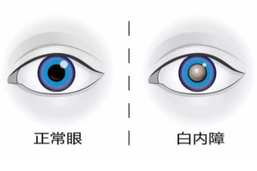 20年经验眼科医生解答:白内障晶体植入能做二次手术吗?
