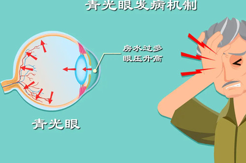2024青光眼激光手术价格是多少?青光眼治疗成本分析与选择建议