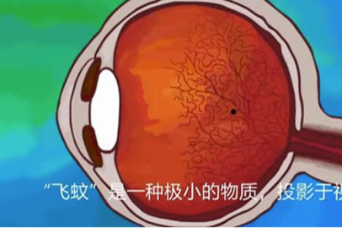飞蚊症不管的话会不会一直加重,怎样判断飞蚊症的严重程度?