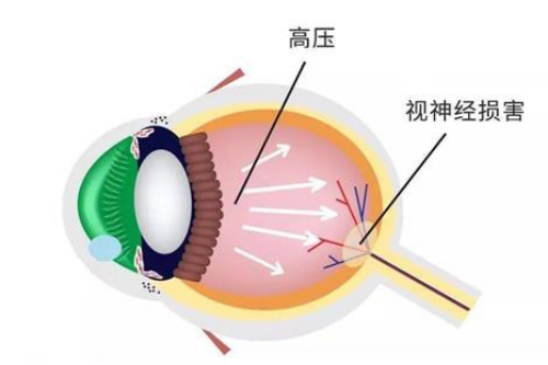 青光眼伴视网膜萎缩:手术治疗能否逆转?潜在风险知多少?