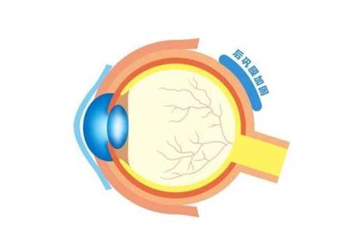 后巩膜加固术后近视还发展吗?视力能提高多少?