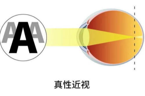 请问真性近视还能恢复正常视力吗？其中的原理及矫正方法告诉大家！