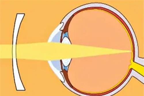 屈光近视和轴性近视有什么区别?它们的病因和诊断方法有所不同