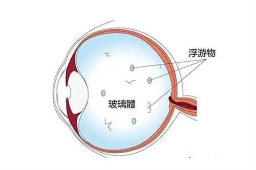 了解一下:飞蚊症确诊需要进行哪些检查?