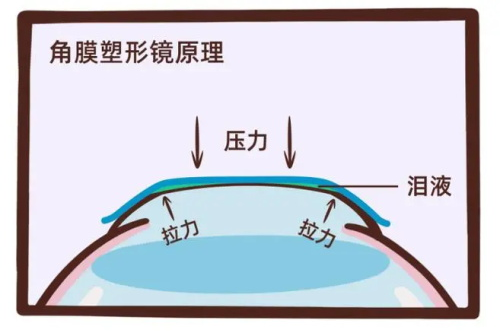 3年后佩戴角膜塑形镜:我的视力变化和心得分享