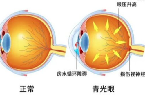 青光眼一般几年失明,想知道2024年做青光眼手术大概需要多少钱?