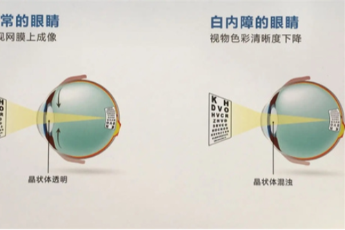 眼睛白球上有白状块物是白内障吗,想知道初期白内障有哪些症状和表现?