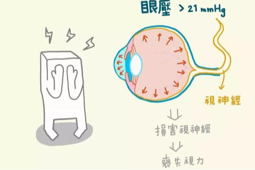 详解青光眼的症状和表现,以及青光眼好的恢复方法!