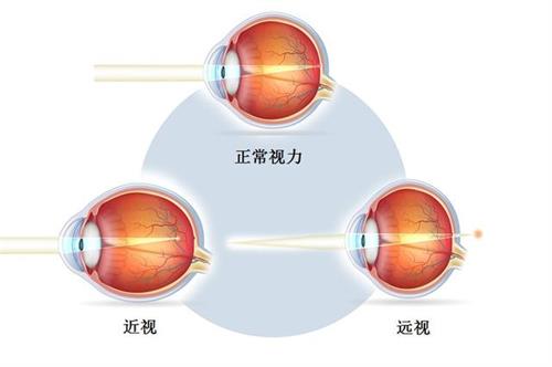 近视眼示意图