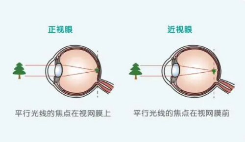近视眼示意图