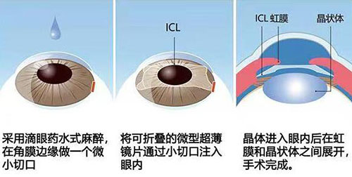 白内障流程示意图