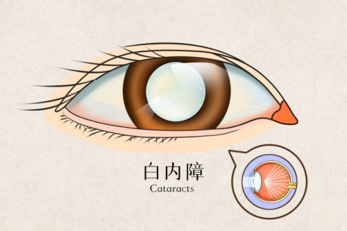 【眼病知识科普】白内障多久会导致眼睛失明?