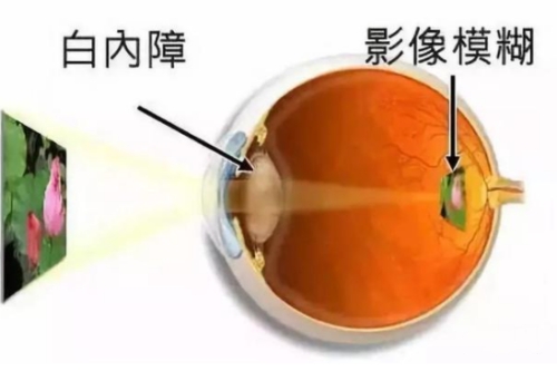 白内障会导致视线模糊