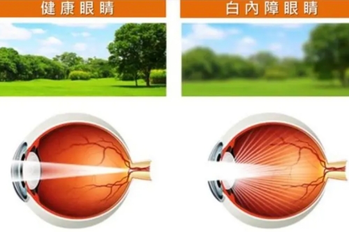 健康眼睛与白内障视线区别