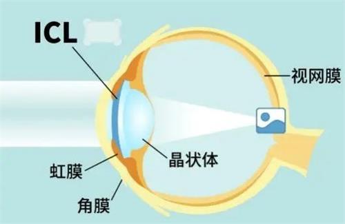 icl晶体植入的部位