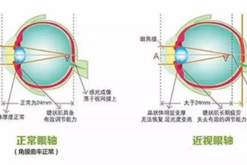 正常眼睛和近视眼睛区别