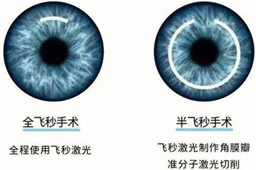 激光治疗近视眼方式对比