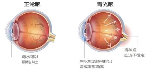 青光眼示意图
