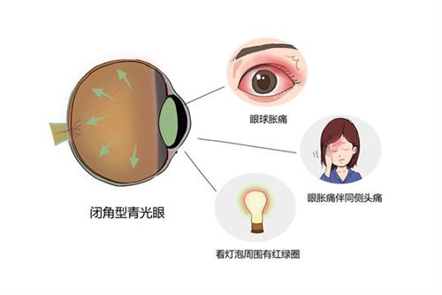 青光眼的表现示意图