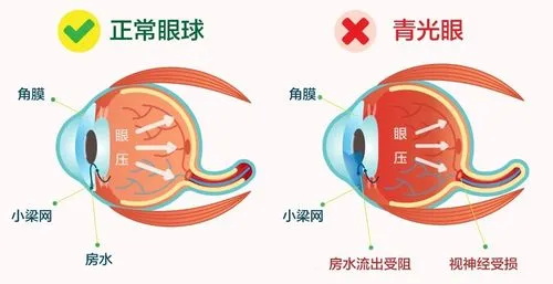 青光眼和正常眼球示意图