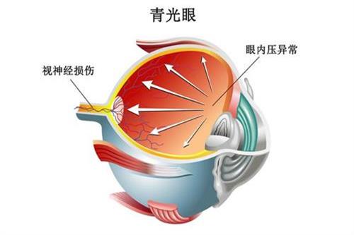 青光眼的症状和表现是什么?怎么造成的及治疗方法解析
