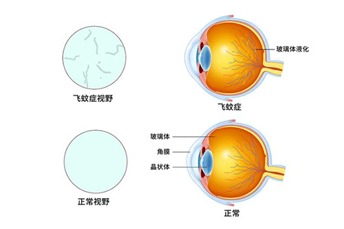 正常眼睛和飞蚊症对比