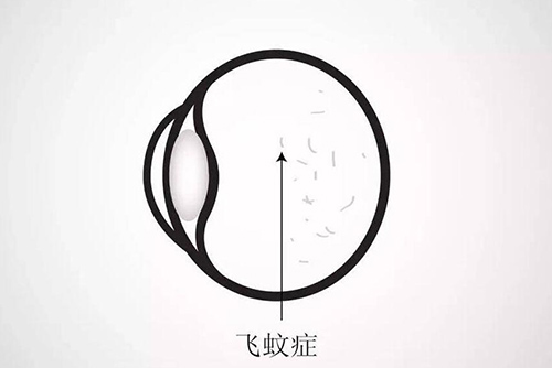 飞蚊症卡通图展示照片