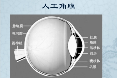 人工角膜展示图