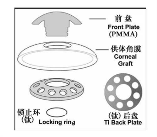 领扣型人工角膜的组成