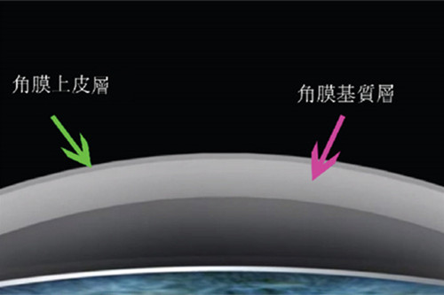 圆锥角膜变化示例图