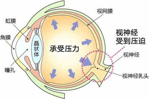 青光眼一定会失明吗?分享青光眼从出现到致盲的过程