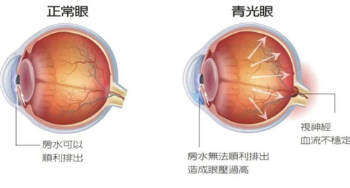 青光眼和正常眼眼球示意图