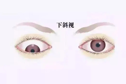 下斜视卡通示意图