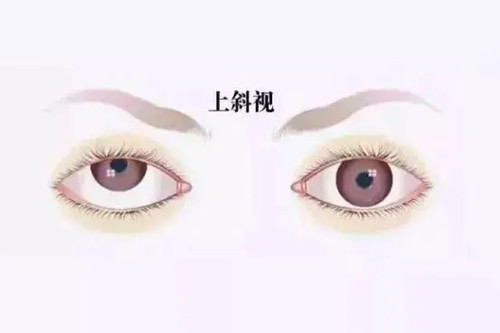 上斜视卡通示意图